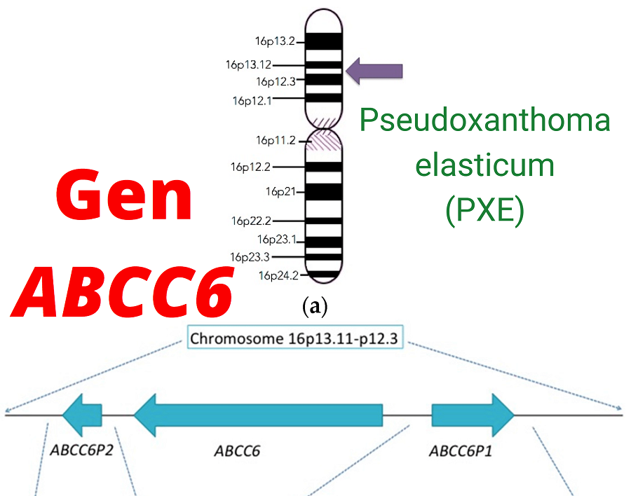 Gen ABCC6 và bệnh di truyền lặn trên nhiễm sắc thể thường